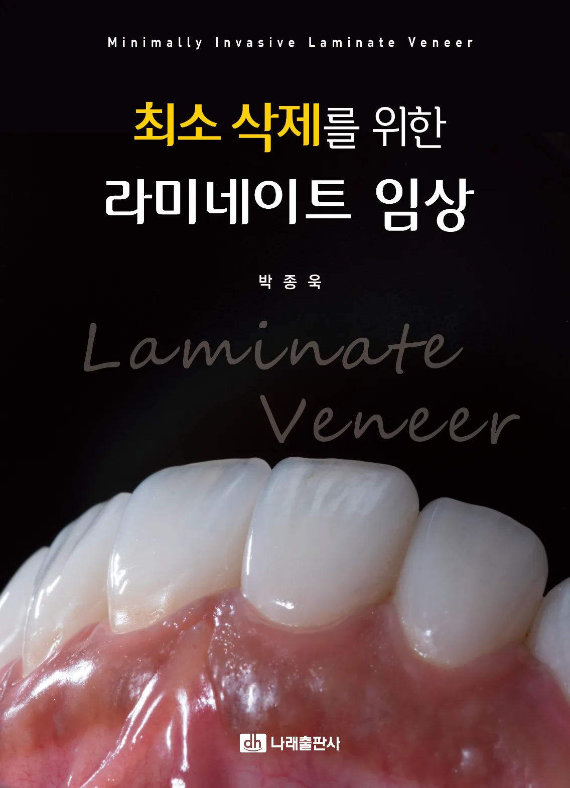 『최소삭제를 위한 라미네이트 임상』