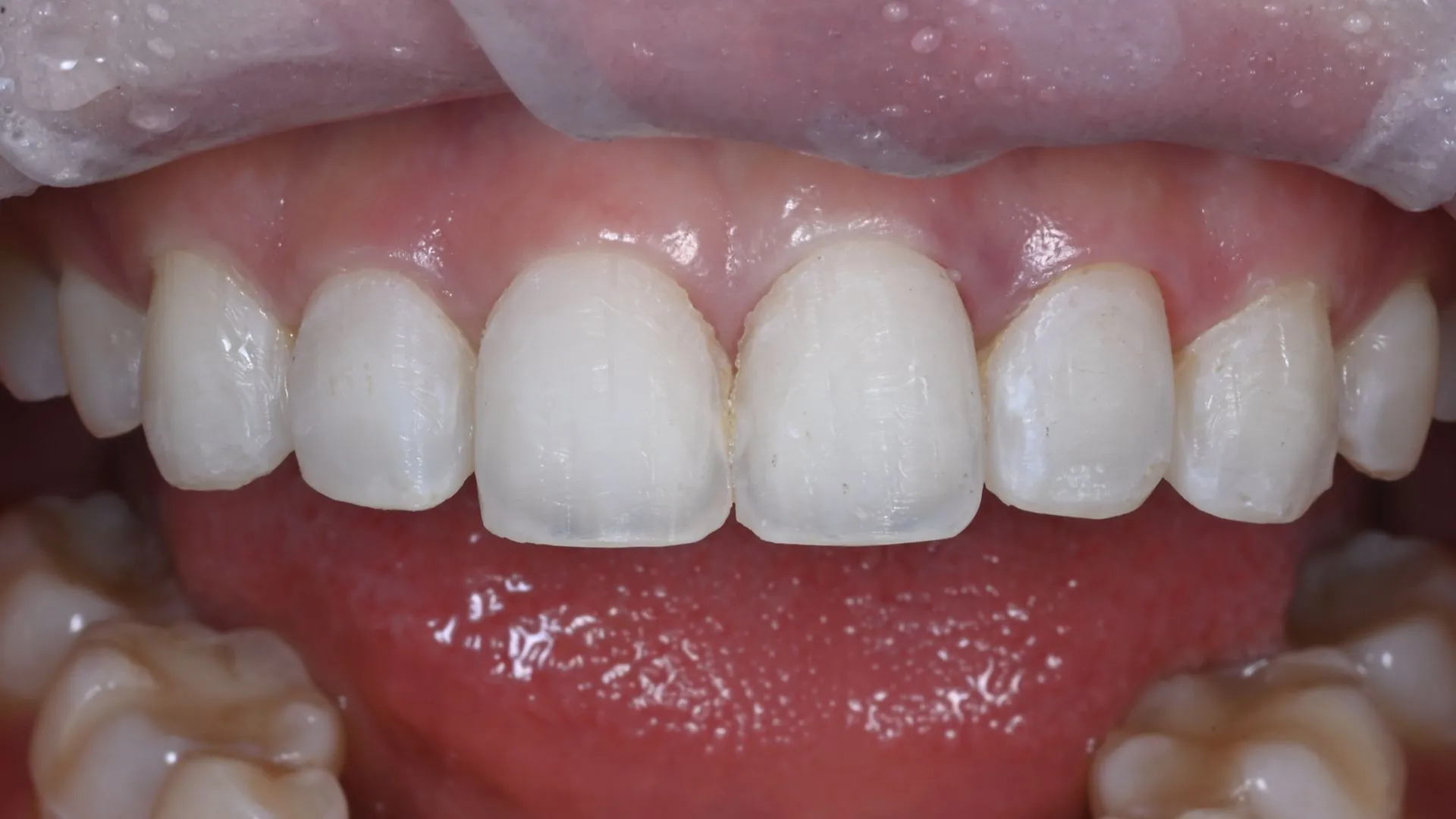 제거 후: 손상 없는 치면