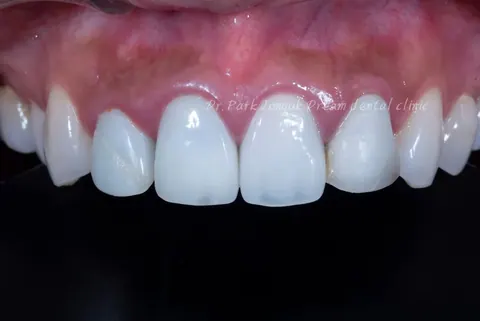 라미네이트 재치료 - 파절과 심미 그리고 염증까지 해결한 케이스
