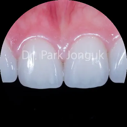 라미네이트 재치료 본문 사진 7