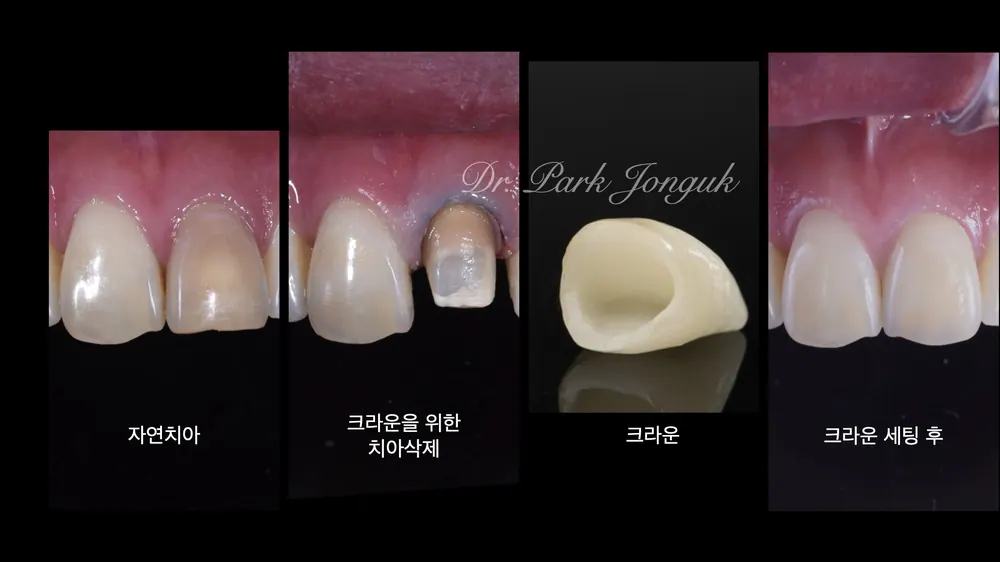 라미네이트 올세라믹 크라운 재치료 부자연스러운 색과 치아 변색 본문 사진 2