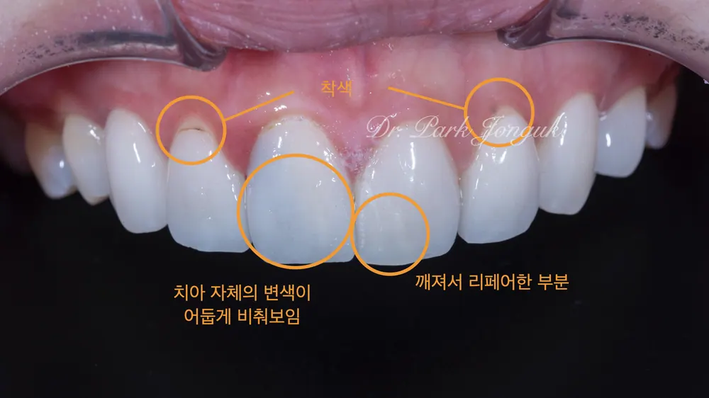 라미네이트 올세라믹 크라운 재치료 부자연스러운 색과 치아 변색 본문 사진 4