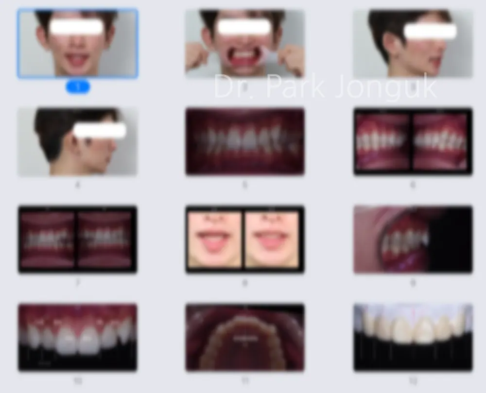 삭제량까지 미리 확인 가능한 앞니 라미네이트 치료 과정 본문 사진 2