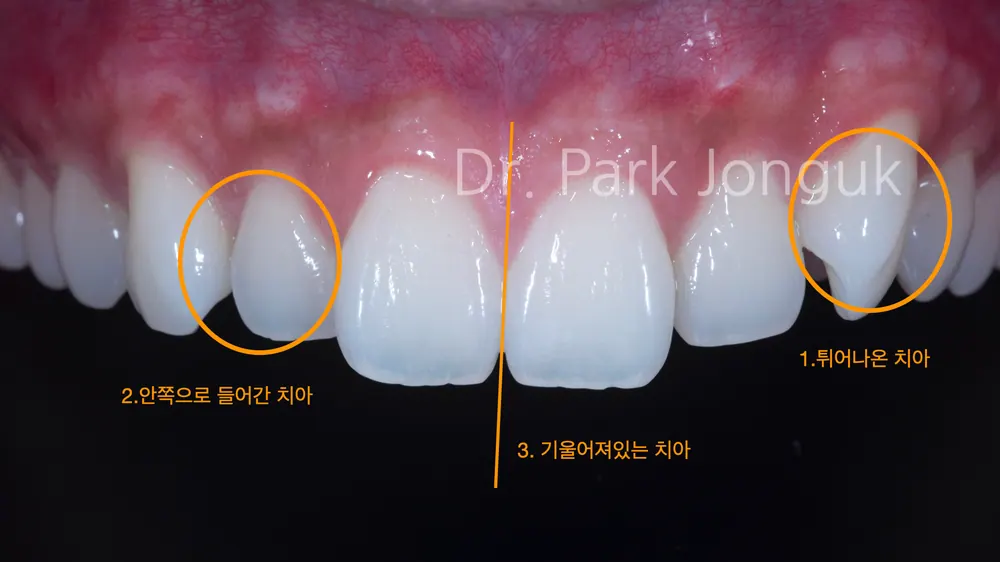 삭제량까지 미리 확인 가능한 앞니 라미네이트 치료 과정 본문 사진 4