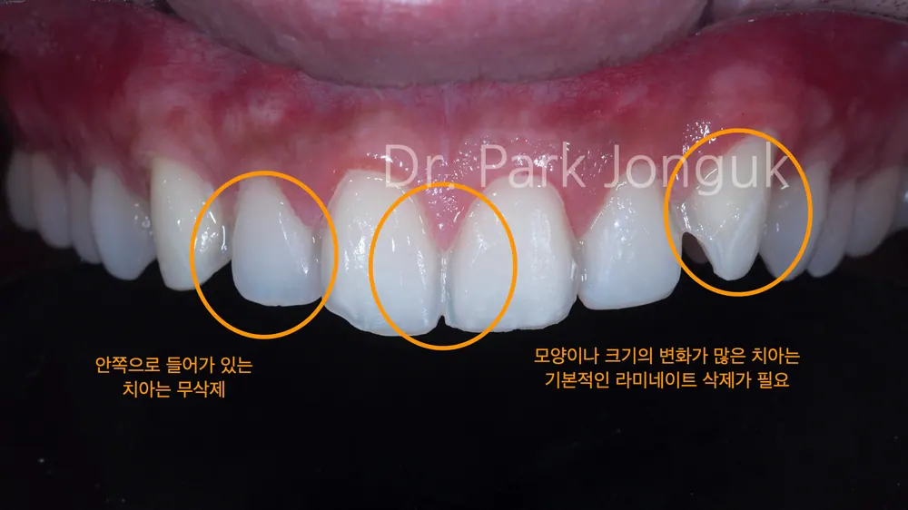 삭제량까지 미리 확인 가능한 앞니 라미네이트 치료 과정 본문 사진 7