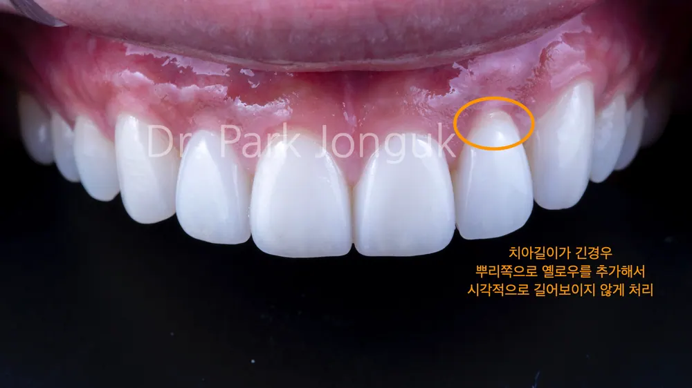 삭제량까지 미리 확인 가능한 앞니 라미네이트 치료 과정 본문 사진 12
