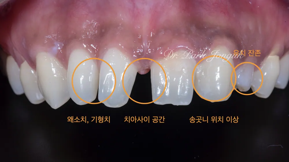 드라마틱한 라미네이트 치아성형 치료 자연스럽게 본문 사진 2