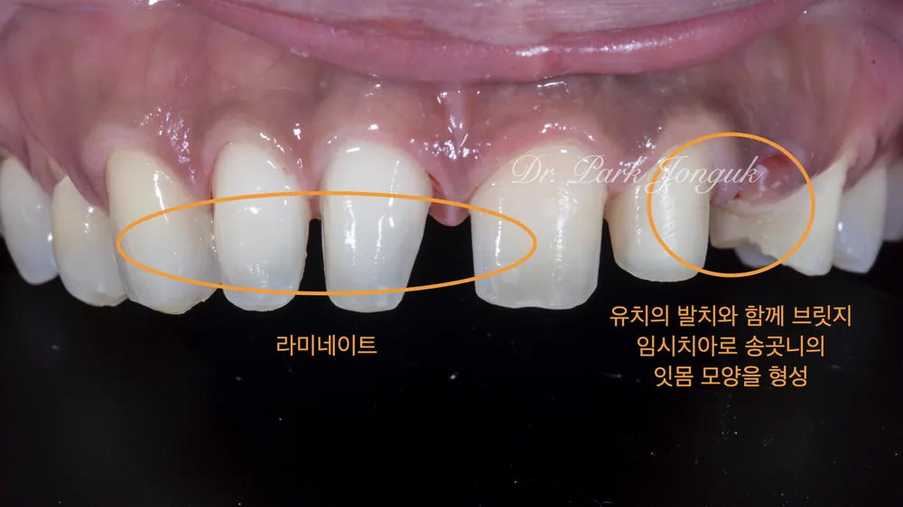 드라마틱한 라미네이트 치아성형 치료 자연스럽게 본문 사진 5