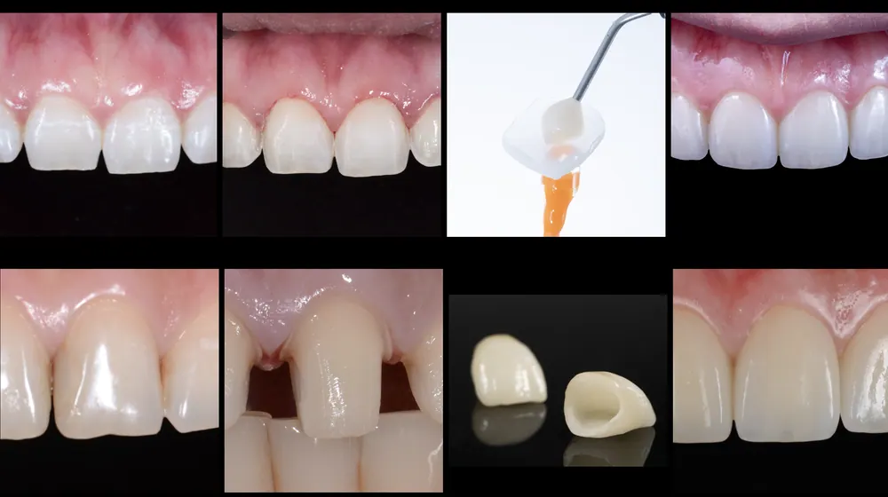 청담동치과잘하는곳 올세라믹 크라운과 라미네이트의 조화 본문 사진 1