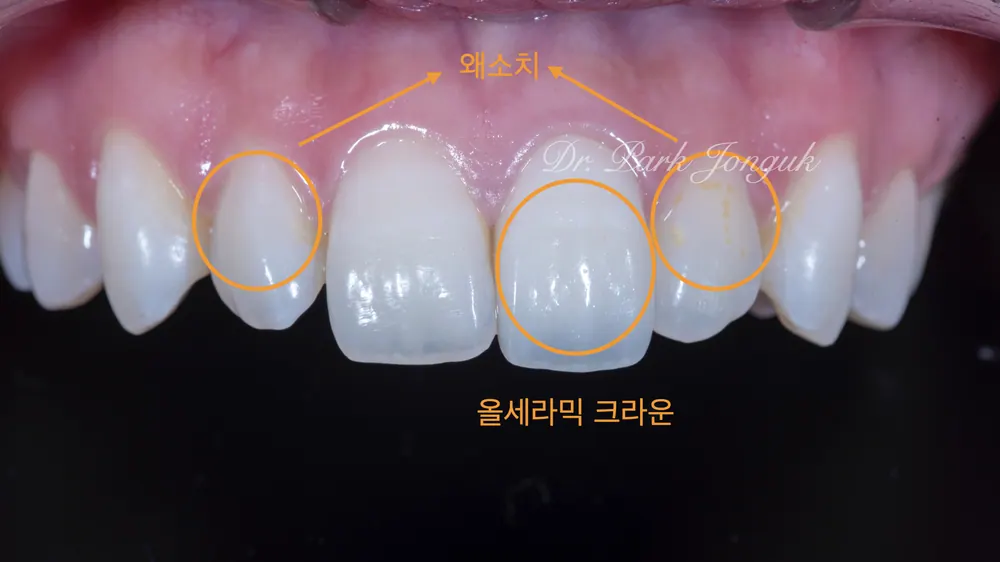 압구정역치과추천 올세라믹 크라운 재치료와 왜소치 치료 본문 사진 2