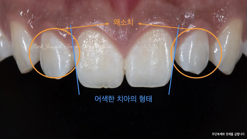 강남 무삭제 라미네이트 자연스러움이 포인트 본문 사진 2