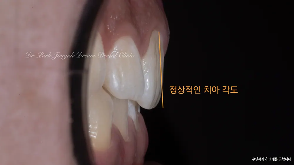 강남 무삭제 라미네이트 자연스러움이 포인트 본문 사진 3