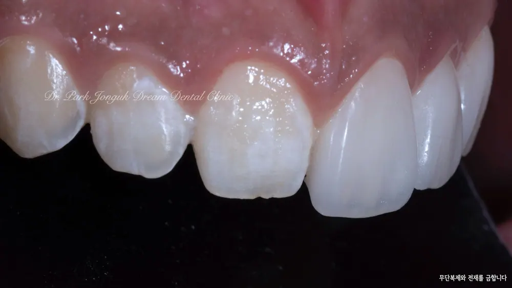 강남 무삭제 라미네이트 자연스러움이 포인트 본문 사진 10