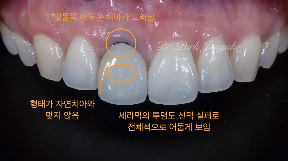 압구정치과잘하는곳 잇몸까지 변색이 심한 올세라믹 크라운의 재치료 본문 사진 2