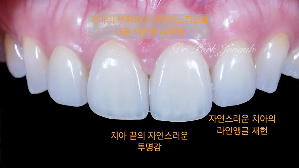 강남라미네이트재치료 자연스러운 모양과 색으로 본문 사진 6