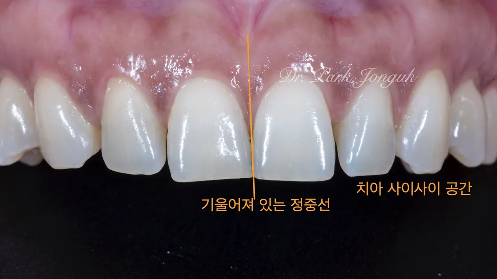 청담동라미네이트 정확한 삭제가 필수인 라미네이트 치료 과정 본문 사진 2