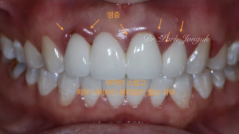 압구정동치과잘하는곳 염증이 심한 앞니 크라운의 재제작 본문 사진 2