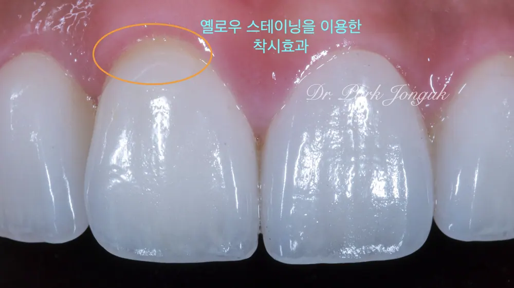 강남라미네이트잘하는치과 뻐드러진 치아의 라미네이트 본문 사진 10