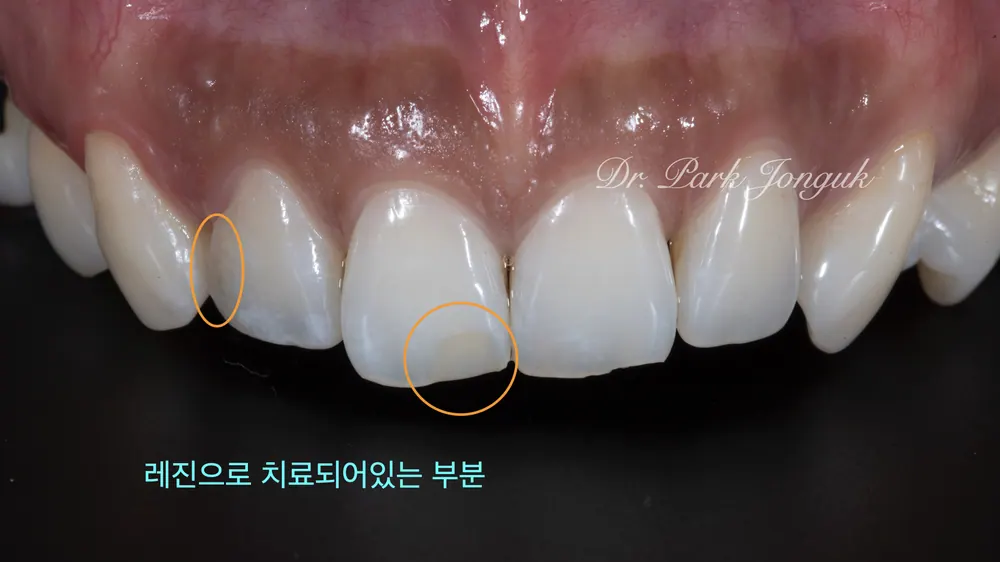 서울라미네이트잘하는곳 자연스러움이 포인트 본문 사진 3