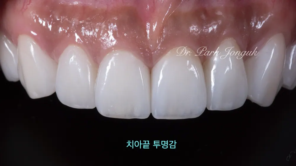 서울라미네이트잘하는곳 자연스러움이 포인트 본문 사진 5