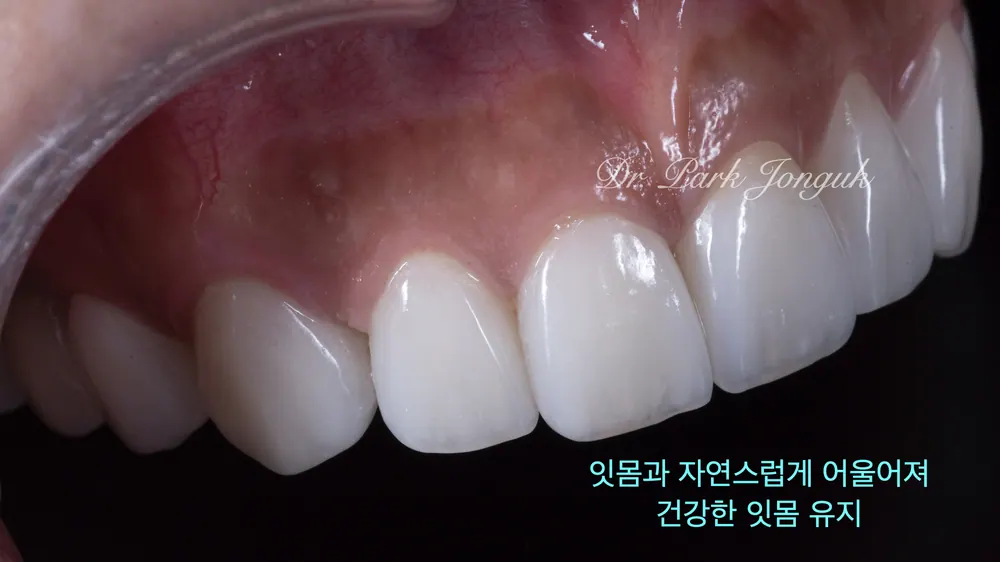 서울라미네이트잘하는곳 자연스러움이 포인트 본문 사진 6