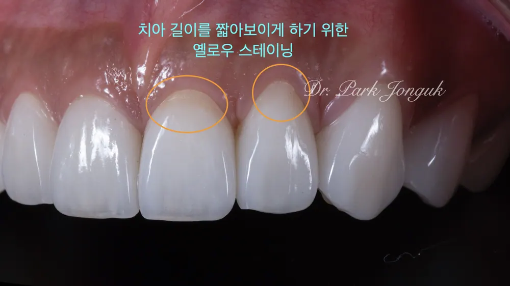 서울라미네이트잘하는곳 자연스러움이 포인트 본문 사진 7