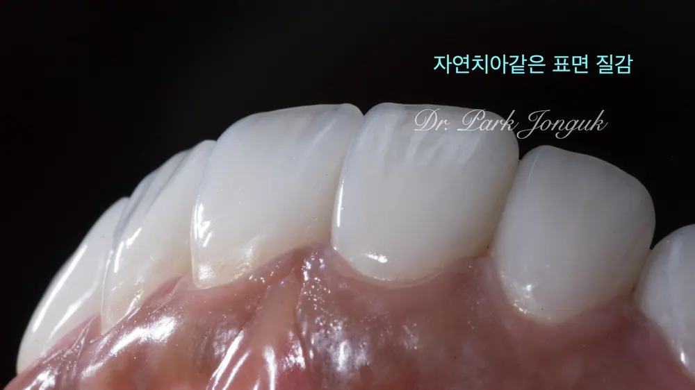 서울라미네이트잘하는곳 자연스러움이 포인트 본문 사진 9
