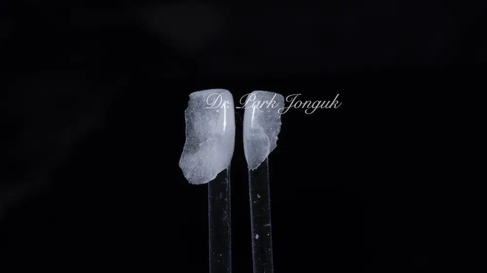 벌어진 치아 라미네이트 부분 무삭제 진행 사례 본문 사진 2