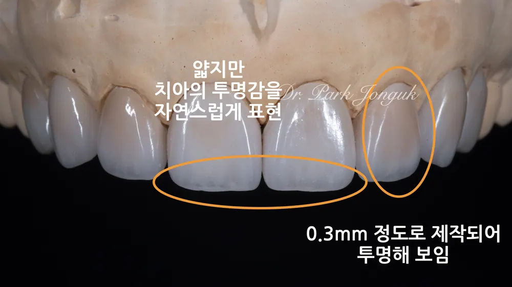 토끼이빨라미네이트 자연스럽게 마무리 본문 사진 3