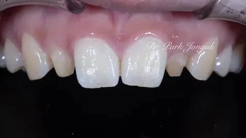 큰 치아 라미네이트 치아가 큰 경우에도 OK