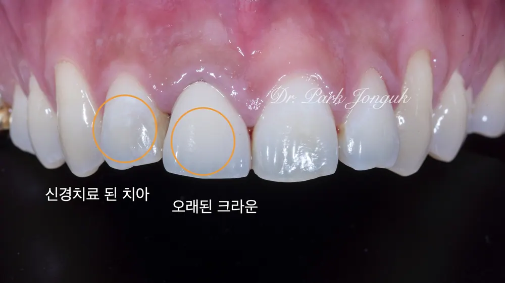 올세라믹 크라운과 라미네이트 같이 할 때 중요한 점 본문 사진 2