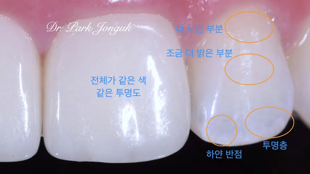 앞니 라미네이트 재치료 사례 살펴보기 본문 사진 2