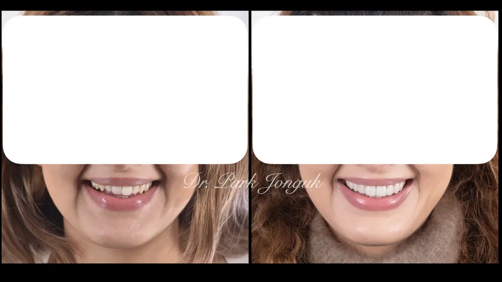 얼굴과 함께 생각하는 라미네이트치료 본문 사진 11