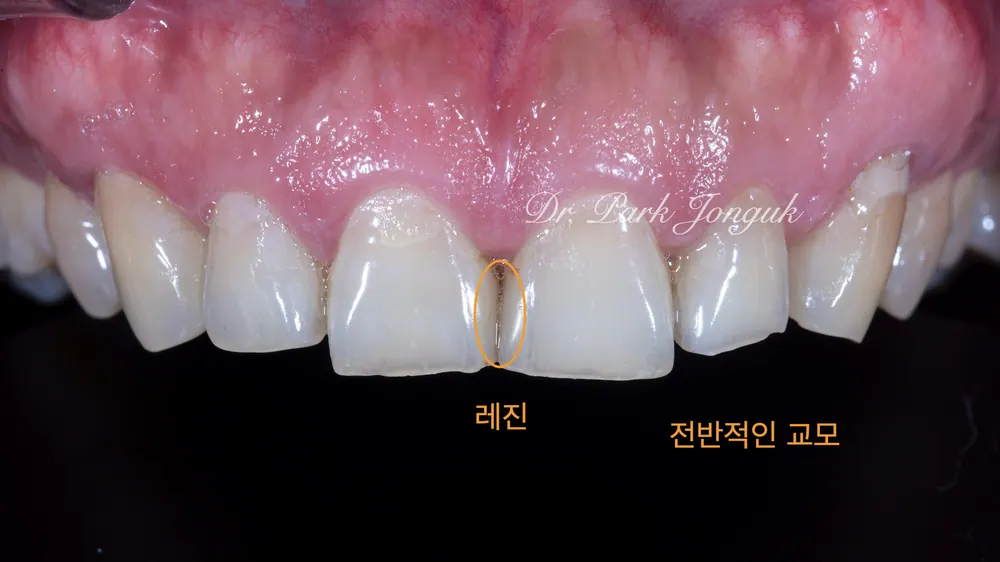 치아를 젊어 보이게! 나이 들어 보이는 마모된 치아의 라미네이트 본문 사진 2