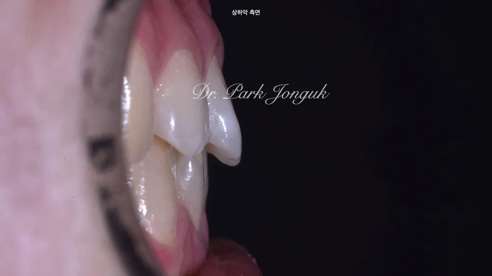 청담동라미네이트 뻐드러지고 벌어진 치아의 라미네이트 치료 사례 본문 사진 2