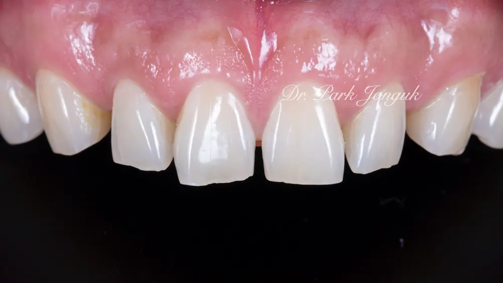 무삭제 라미네이트를 이용한 치아성형 본문 사진 1