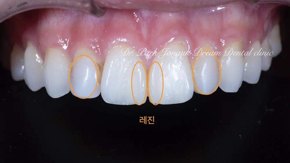 심미적 목적의 최소삭제 라미네이트 본문 사진 2