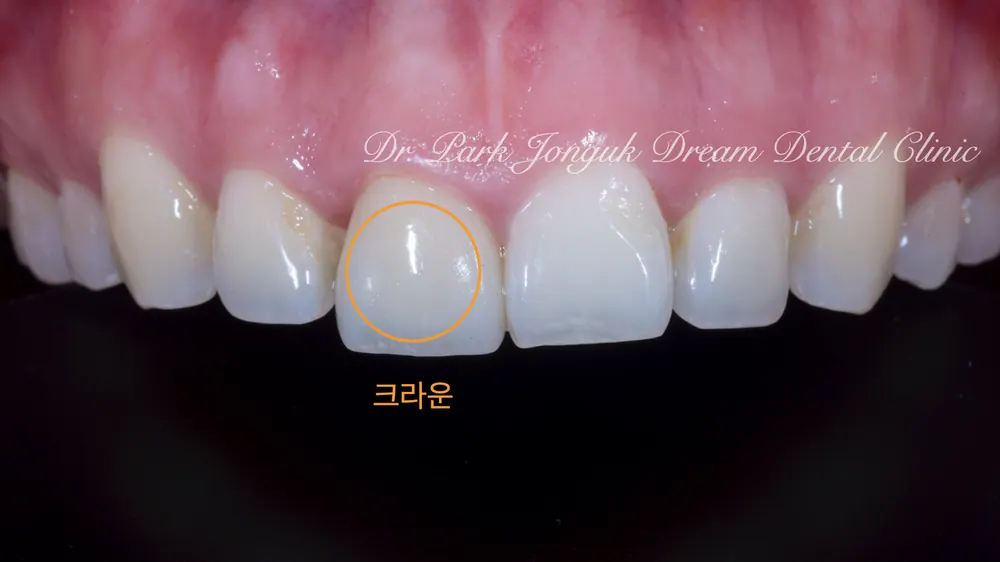 신사라미네이트와 올세라믹 크라운을 이용한 치아성형 본문 사진 2