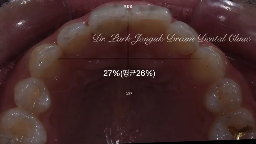 신사라미네이트와 올세라믹 크라운을 이용한 치아성형 본문 사진 4