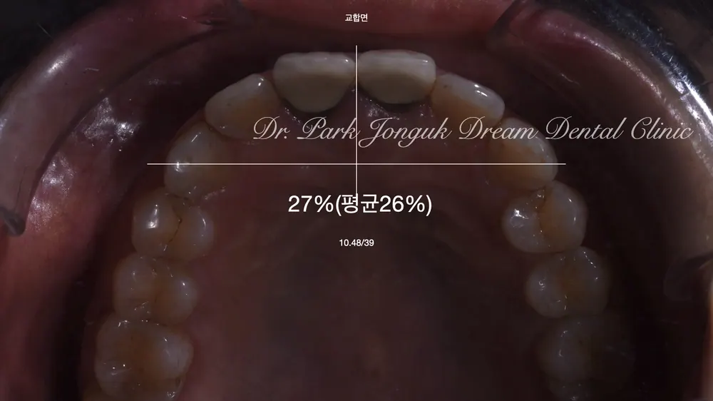 잇몸변색, 잇몸색이 검게 된 오래된 크라운의 재시술 본문 사진 4
