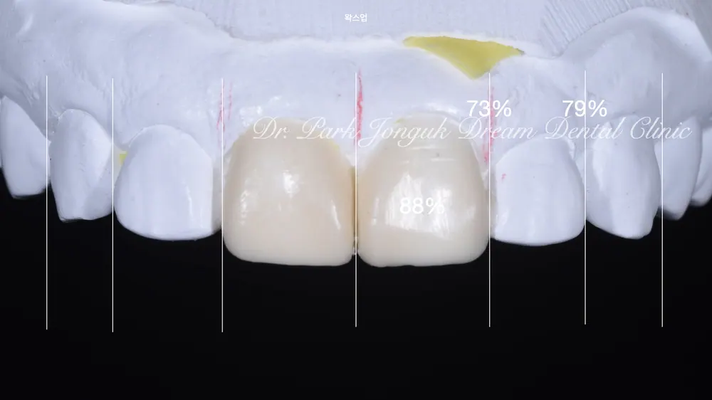 잇몸변색, 잇몸색이 검게 된 오래된 크라운의 재시술 본문 사진 5