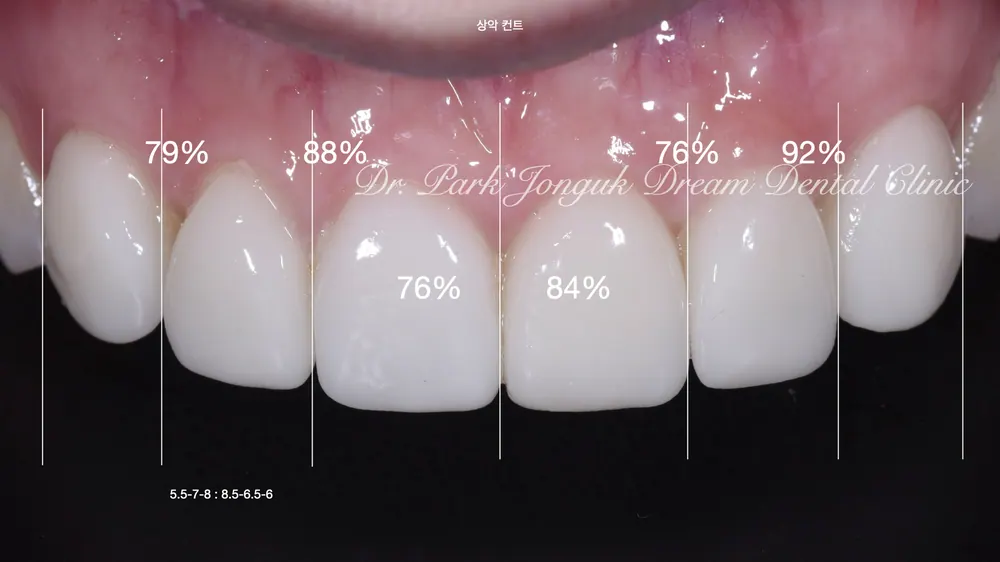 인공적인 라미네이트를 자연스러운 라미네이트로 재시술 2부 본문 사진 4