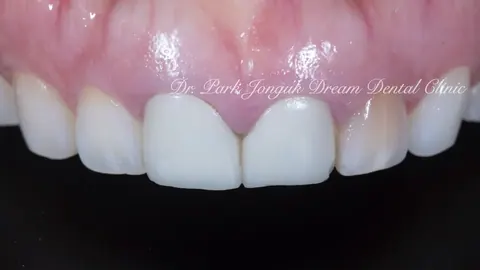 변색된 치아 라미네이트 치료 - 올세라믹 크라운 재시술