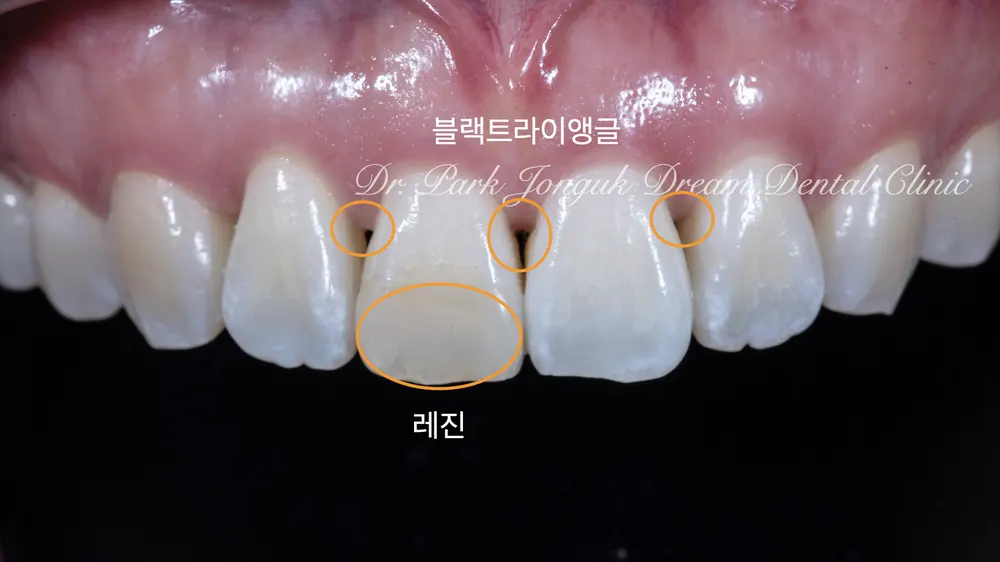 미세한 삭제만을 하면서 블랙트라이앵글을 라미네이트로 치료하기 본문 사진 2