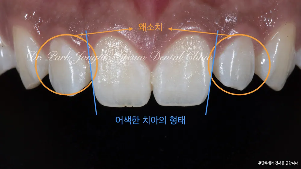 무삭제 라미네이트 치료 사례 살펴보기 본문 사진 2