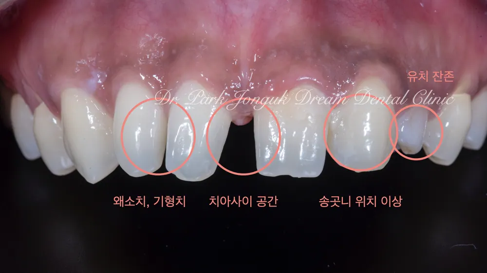 벌어진 치아, 기형치의 앞니 라미네이트 본문 사진 2