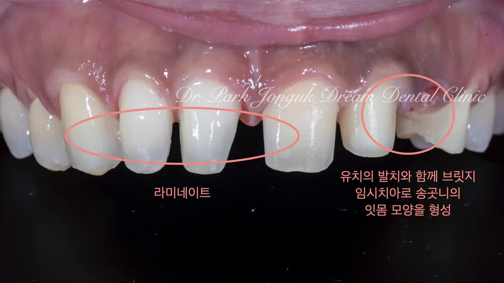 벌어진 치아, 기형치의 앞니 라미네이트 본문 사진 4