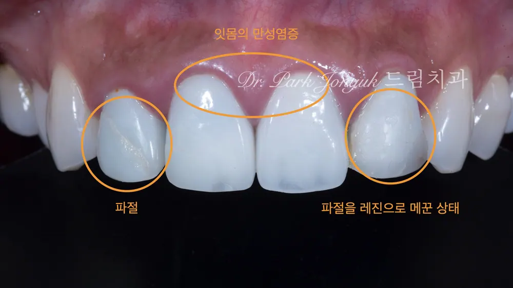 강남라미네이트, 올세라믹 크라운의 재시술 본문 사진 2