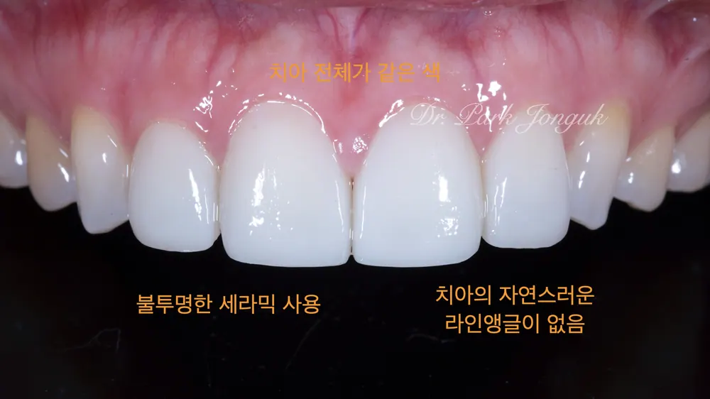 라미네이트 재치료 진행한 사례 본문 사진 2