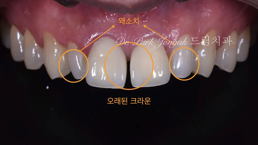 왜소치 라미네이트와 벌어진 치아, 올세라믹 크라운의 재시술 본문 사진 3